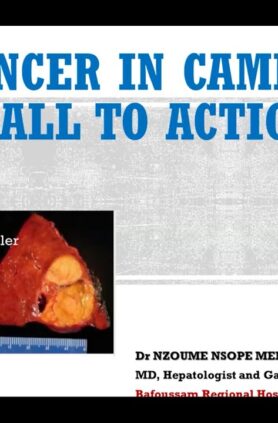 Liver Cancer in Cameroon Urgent Call To Action